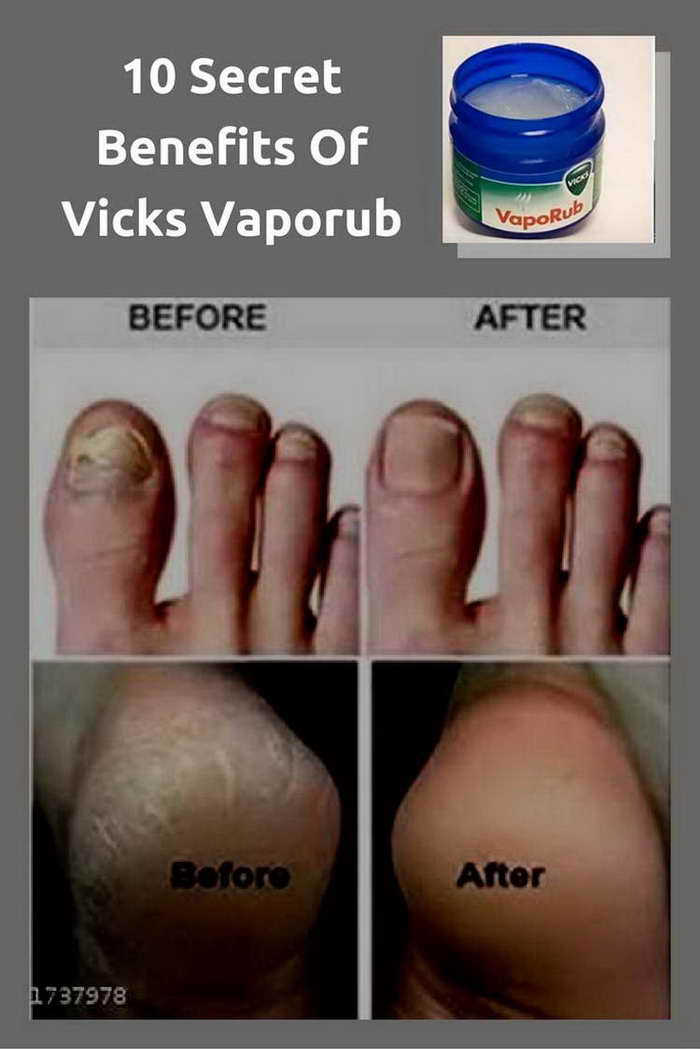 10 Secret Benefits Of Vicks Vaporub
