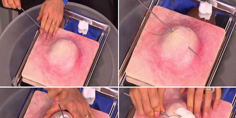 Doctor Reveals Best Way To Attack A Pimple Without Damaging Your Skin