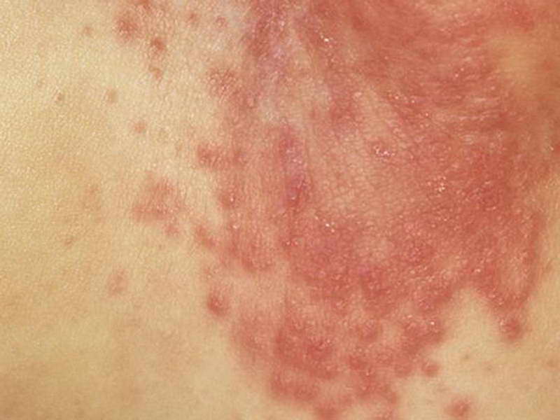 how can proper hygiene prevent fungal infection