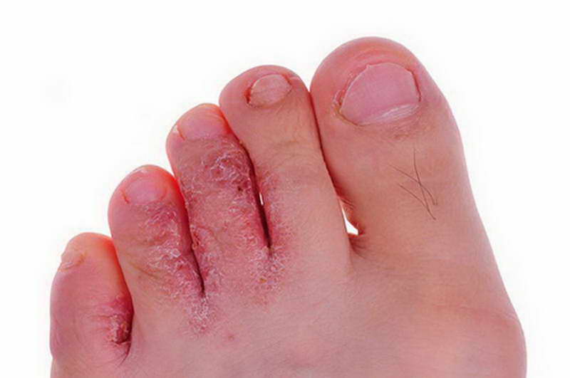 food to prevent fungal infection fungal infection prevent facial how can i prevent fungal infections