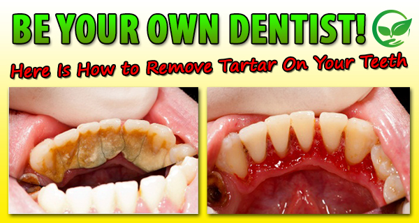 How to get rid of build up tartar on teeth What To Know About Tartar Build Up And Your Teeth Snodgrass King